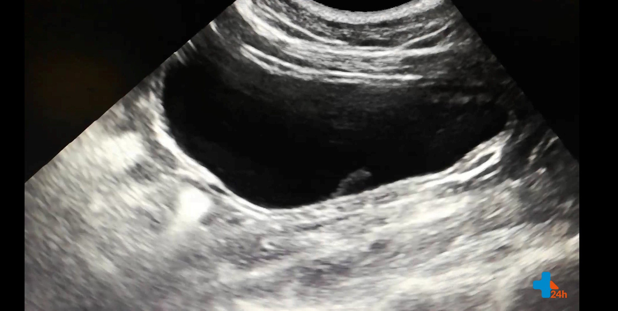 usg pęcherz moczowy.jpg