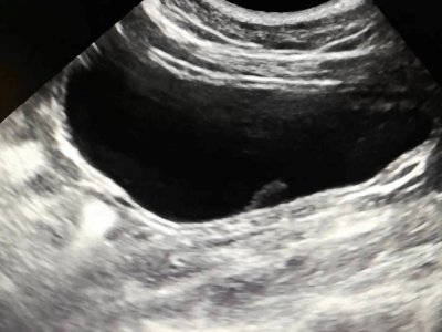 usg pęcherz moczowy